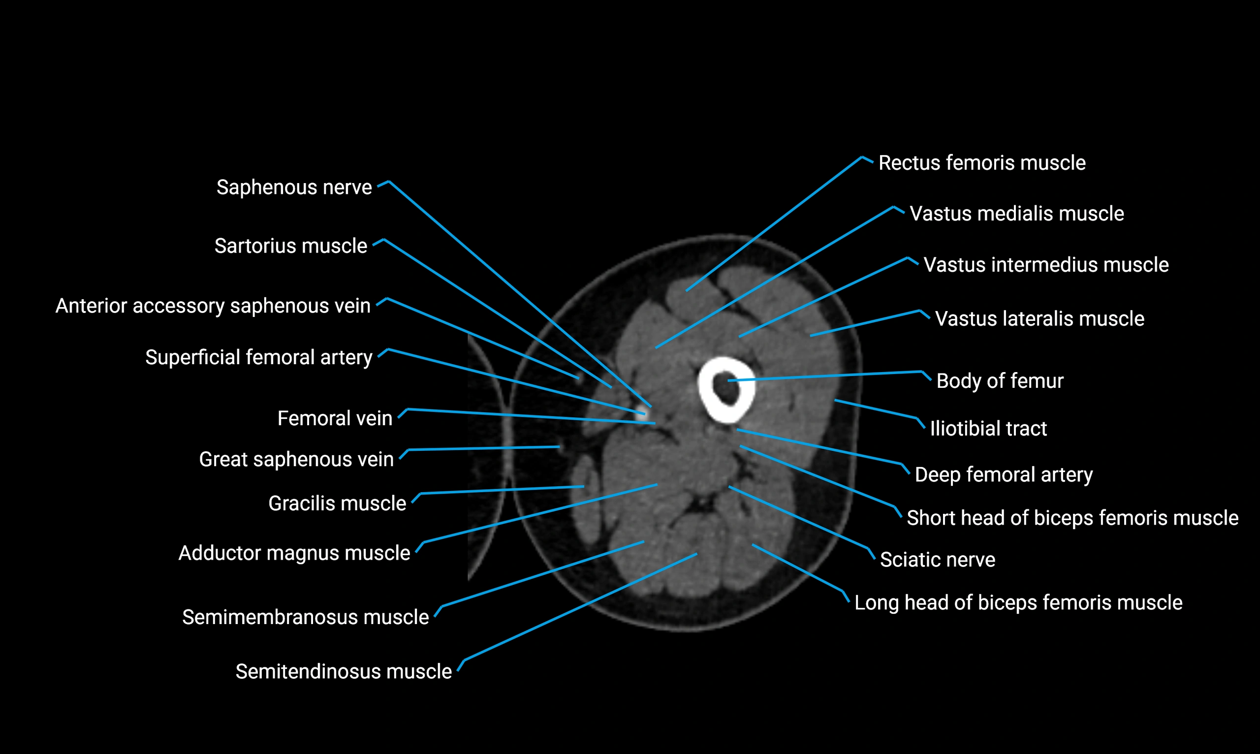 CT lower limb axial cross sectional anatomy labelled image 52 (2).webp